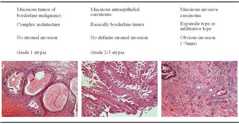 Serous Ovarian Cancer Histology - CancerWalls