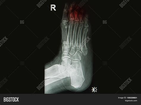 X-rays Image Injury Image & Photo (Free Trial) | Bigstock