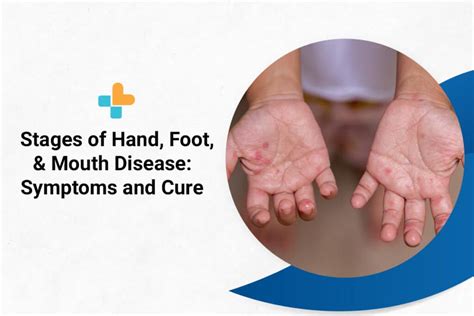 Stages Of Hand, Foot, And Mouth Disease: Symptoms And Cure