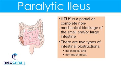 Ogilvie Syndrome Vs Ileus - Pregnant Center Informations