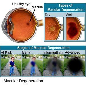 Macular Degeneration - What You Need to Know