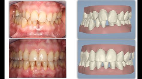 Amazing Invisalign Crossbite Orthodontic Treatment & incisor extraction ...