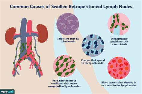 Enlarged Retroperitoneal Lymph Nodes: Causes and More