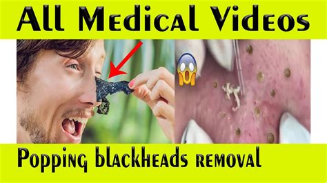 Blackheads Being Popped 2024 - Robbi Christen