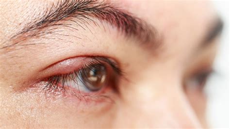 What Is a Stye? Causes, Treatment, and Other FAQs - GoodRx