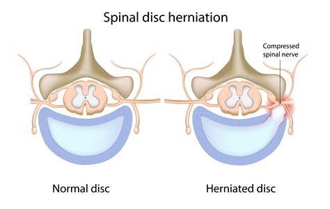 5 Common Symptoms of Lumbar Disc Herniations - Elite Sports and Spine ...