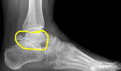 Subatalar Osteoarthritis - Dr Warren