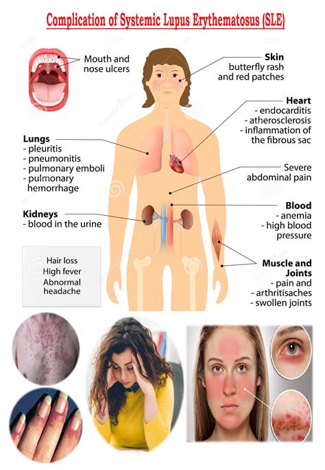 Systemic Lupus Erythematosus (SLE) - MedicoInfo