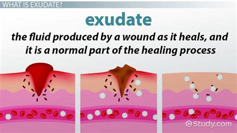 Exudate: Definition & Types - Lesson | Study.com