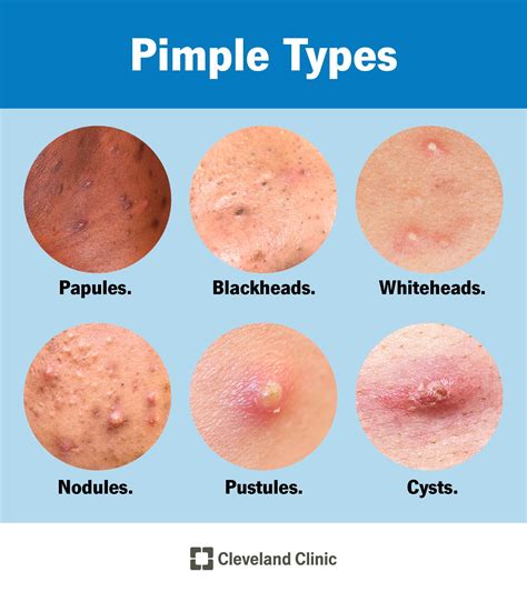 Pimples: Causes vs. Acne, Types & Treatment