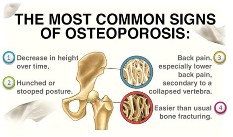 group_5_presentation_1_-_osteoporosis - Wiki