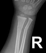 Greenstick Fracture X Ray