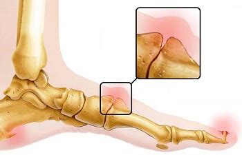 Lump On Top Of Foot: Common Causes & Treatment