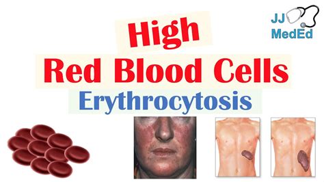 High Red Blood Cells (Erythrocytosis) | Causes, Signs and Symptoms, and ...