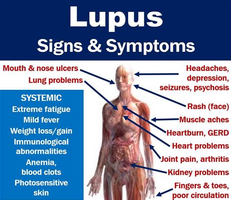 Lupus signs and symptoms with full description of features