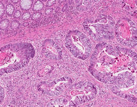 Adenocarcinoma Colon Histology