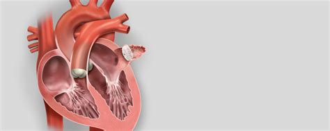 WATCHMAN™ Left Atrial Appendage Closure Device | Warfarin Therapy ...