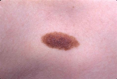 Nevus definition, types, diagnosis & nevus treatment