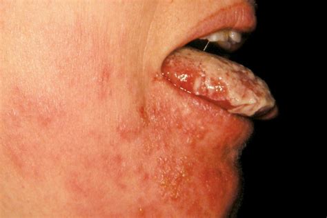 Shingles in the Mouth: Identifying and Treating It