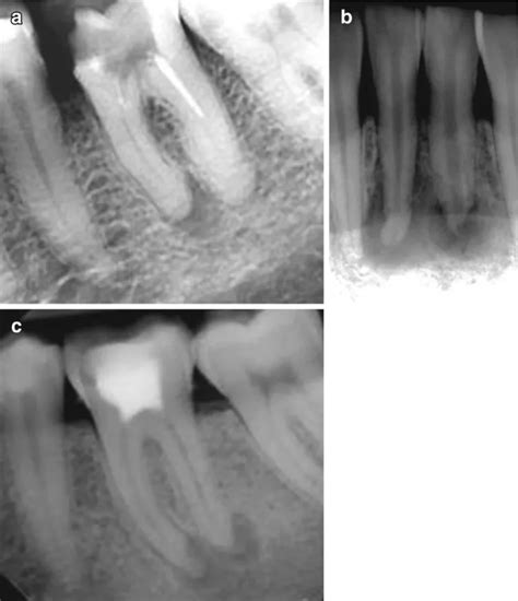 Asymptomatic Apical Periodontitis Causes to Treatment - Denta Master