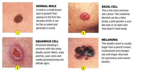 Things You Should Know About Skin Cancer | HubPages