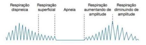 PADRÕES RESPIRATÓRIOS PATÓLOGICOS: RESPIRAÇÃO DE CHEYNE-STOKES ...