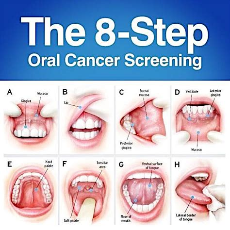 oral-cancer - Spruce Ridge Dental Blog Spruce Ridge Dental Blog