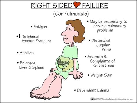 Nursing Mnemonics: Right Sided Heart Failure Nursing School Studying ...