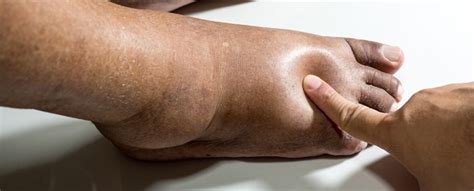 Charcot Foot and Ankle Disease: a quick diagnosis - Orthofix