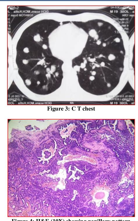 Figure 3 from Papillary Thyroid Carcinoma with Lung Metastasis after 31 ...