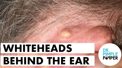 Whiteheads behind the ears, extracted - Bedtime Blackheads - Dr. Pimple ...