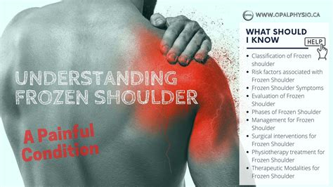 Understanding Frozen Shoulder - A Complete Guide