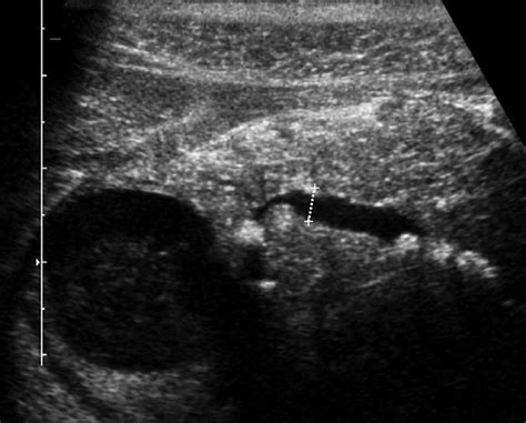 Chronic Pancreatitis Ultrasound