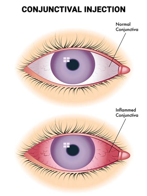 Conjunctival Injection in NYC - Vitreous Retina Macula Consultants of ...