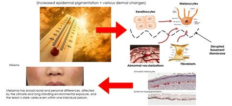 What Is The Main Cause Of Melasma? | Clique Clinic