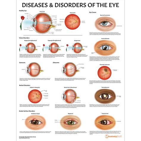 Rare Genetic Eye Diseases