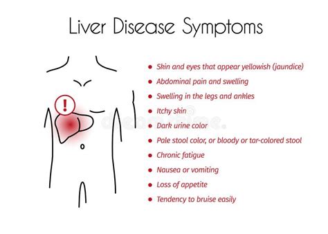 Symptoms of Liver Disease stock vector. Illustration of gallbladder ...