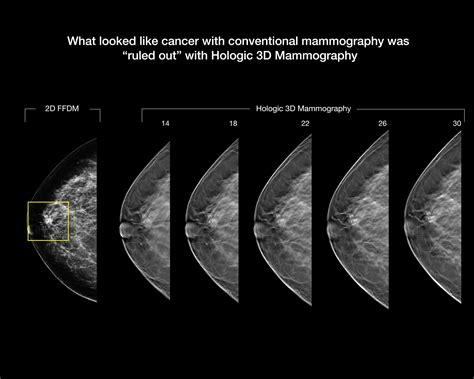 Abnormal Mammogram