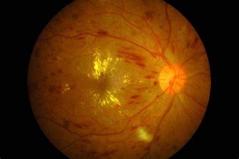 Diabetic retinopathy — Hereford Eye Surgery