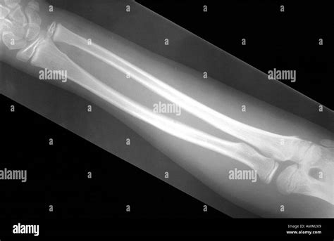 Greenstick Fracture Humerus