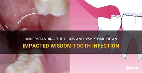 Understanding The Signs And Symptoms Of An Impacted Wisdom Tooth ...