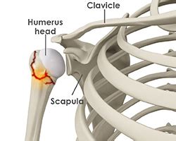 Shoulder Fracture Treatment Chandler, AZ | Shoulder Surgery Casa Grande ...