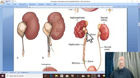 Urology 19 ( Hydronephrosis ) , by Dr. Wahdan . - YouTube