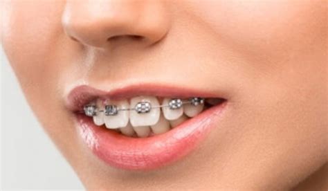 How to Fix an Overbite with Braces? - Transits Blog