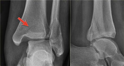 Fracture fragments meaning - grosspush