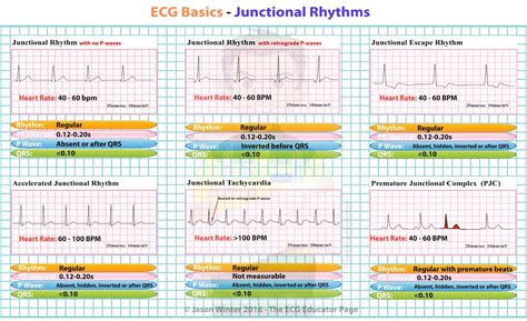 Junctional Rhythm Cheat Sheet