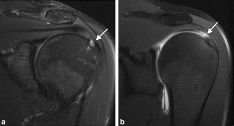 Shoulder Mri Without Contrast