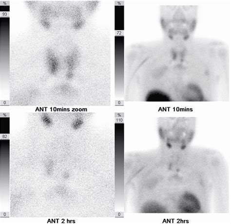 Parathyroid nuclear scan using Technetium (99mTc) sestamibi. Anterior ...