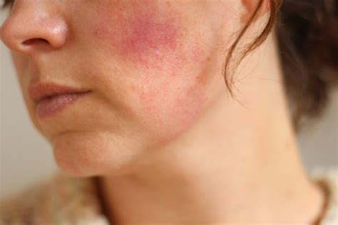 Red Blotches on Face Treatment - Pictures, Causes of Red spots on Face