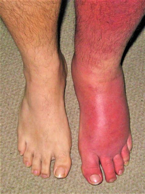 Cellulitis causes, signs, symptoms, diagnosis, prevention and treatment